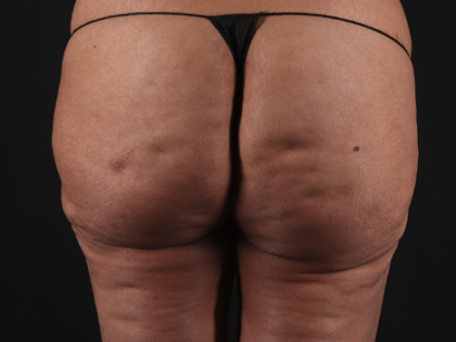 Av&eacute;li Cellulite Treatment Before & After Patient #3481