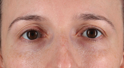 Blepharoplasty (Eyelid Surgery) Before & After Patient #3486