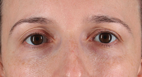 Blepharoplasty (Eyelid Surgery) Before & After Patient #3486