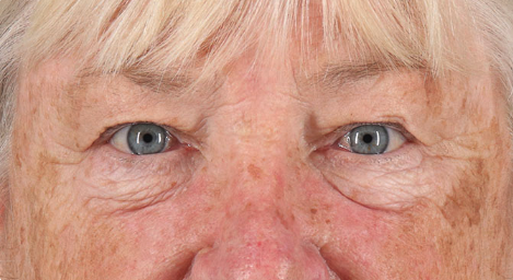Blepharoplasty (Eyelid Surgery) Before & After Patient #3487