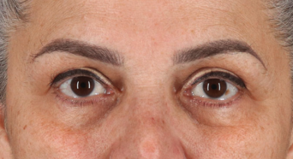 Blepharoplasty (Eyelid Surgery) Before & After Patient #3488