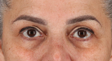 Blepharoplasty (Eyelid Surgery) Before & After Patient #3488