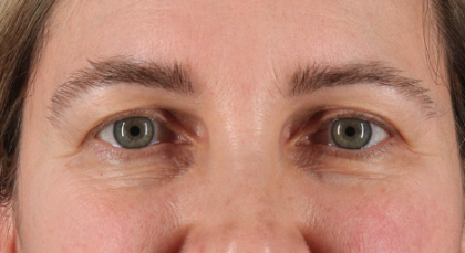 Blepharoplasty (Eyelid Surgery) Before & After Patient #3489