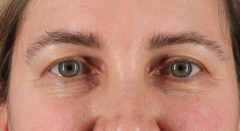 Blepharoplasty (Eyelid Surgery) Before & After Patient #3489