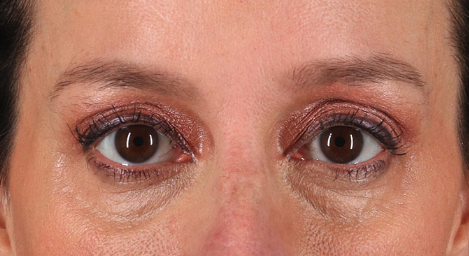 Blepharoplasty (Eyelid Surgery) Before & After Patient #3490
