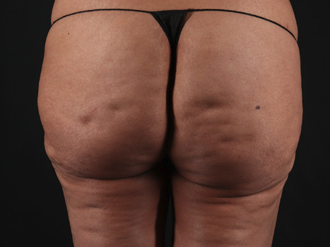 Av&eacute;li Cellulite Treatment Before & After Patient #3481