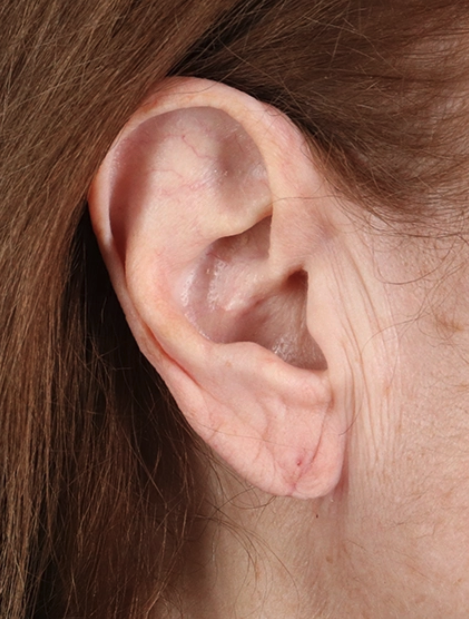 Earlobe Repair Before & After Patient #3482