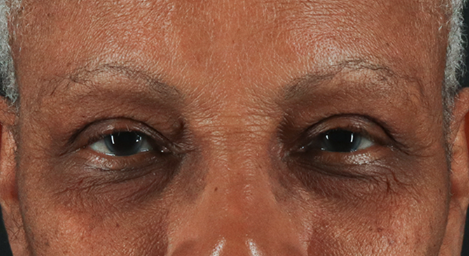 Blepharoplasty (Eyelid Surgery) Before & After Patient #3491