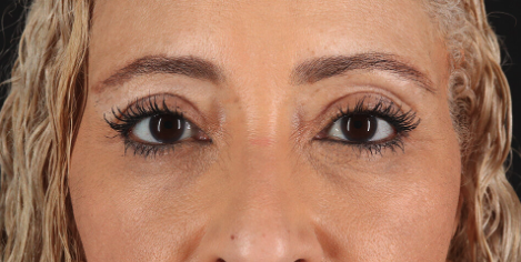 Blepharoplasty (Eyelid Surgery) Before & After Patient #3492