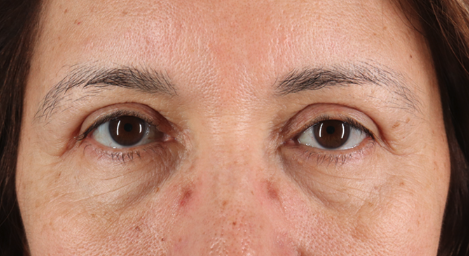 Blepharoplasty (Eyelid Surgery) Before & After Patient #3493