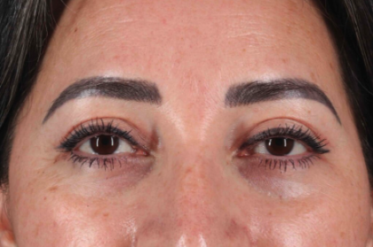 Blepharoplasty (Eyelid Surgery) Before & After Patient #3494