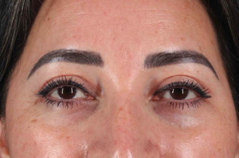 Blepharoplasty (Eyelid Surgery) Before & After Patient #3494