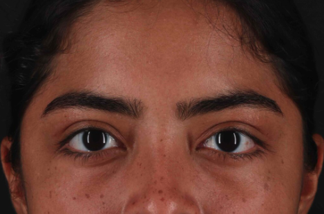 Blepharoplasty (Eyelid Surgery) Before & After Patient #3495