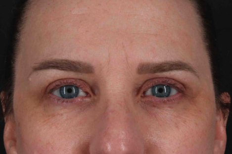 Blepharoplasty (Eyelid Surgery) Before & After Patient #3496