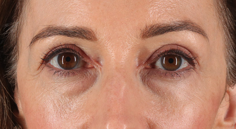 Blepharoplasty (Eyelid Surgery) Before & After Patient #3483