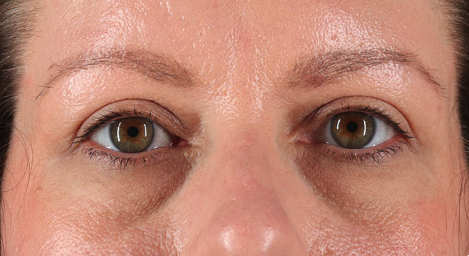 Blepharoplasty (Eyelid Surgery) Before & After Patient #3484