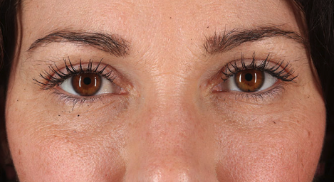 Blepharoplasty (Eyelid Surgery) Before & After Patient #3485