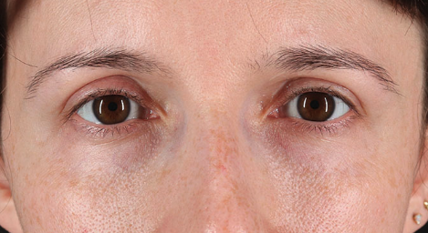 Blepharoplasty (Eyelid Surgery) Before & After Patient #3486