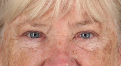 Blepharoplasty (Eyelid Surgery) Before & After Patient #3487