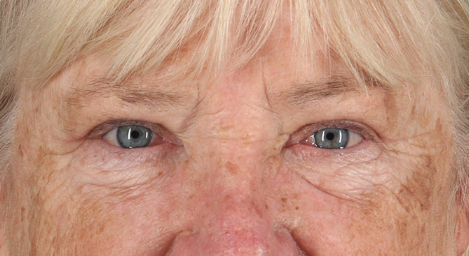 Blepharoplasty (Eyelid Surgery) Before & After Patient #3487
