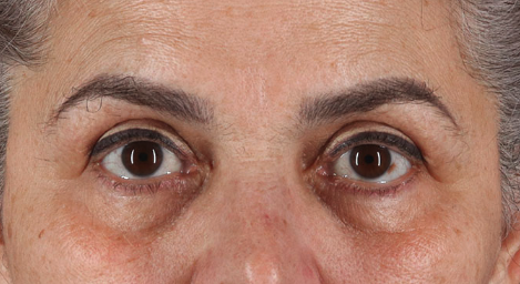 Blepharoplasty (Eyelid Surgery) Before & After Patient #3488