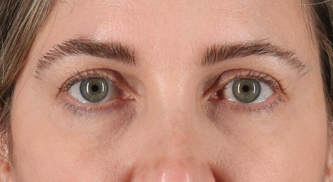Blepharoplasty (Eyelid Surgery) Before & After Patient #3489