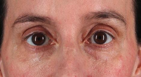 Blepharoplasty (Eyelid Surgery) Before & After Patient #3490