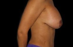 Augmentation/Lift Before & After Patient #4100