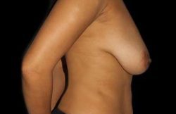 Augmentation/Lift Before & After Patient #4100