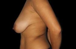 Augmentation/Lift Before & After Patient #4100