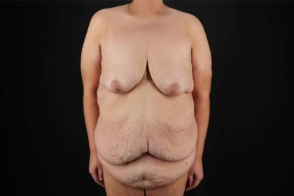 Fleur De Lis Circumferential Body Lift Before & After Patient #4186