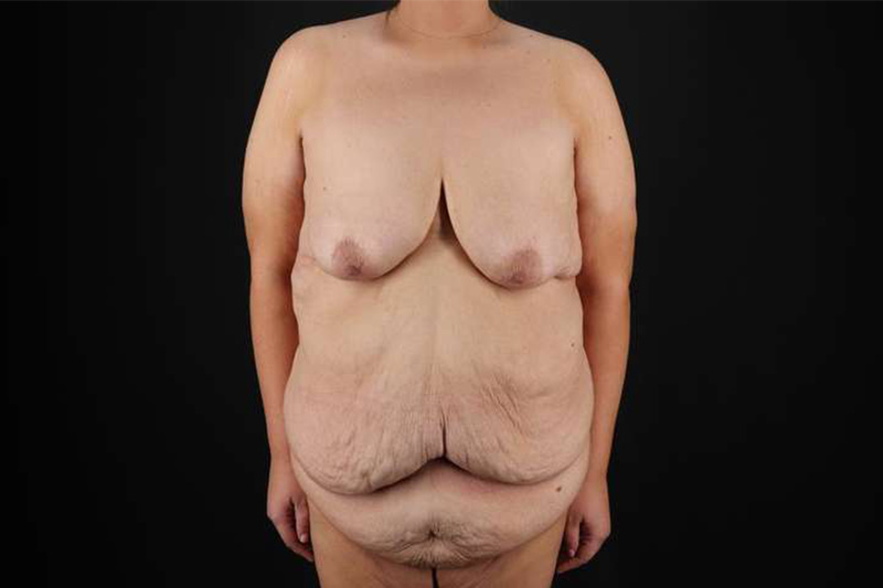 Fleur De Lis Circumferential Body Lift Before & After Patient #4186