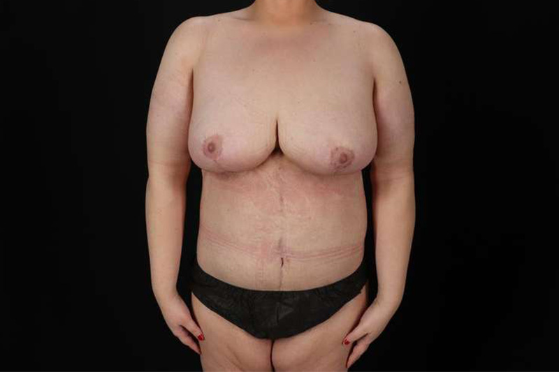 Fleur De Lis Circumferential Body Lift Before & After Patient #4186