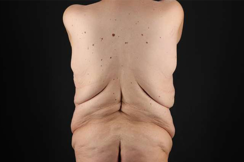 Fleur De Lis Circumferential Body Lift Before & After Patient #4186