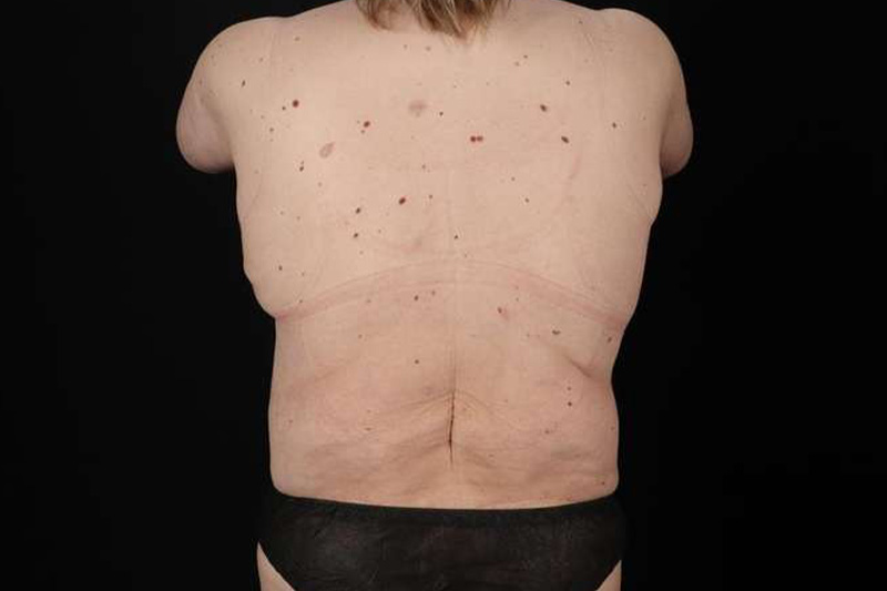 Fleur De Lis Circumferential Body Lift Before & After Patient #4186