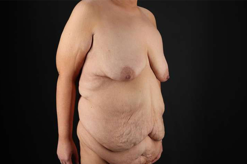 Fleur De Lis Circumferential Body Lift Before & After Patient #4186