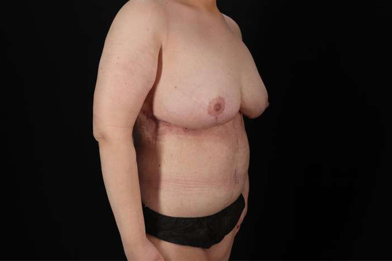 Fleur De Lis Circumferential Body Lift Before & After Patient #4186