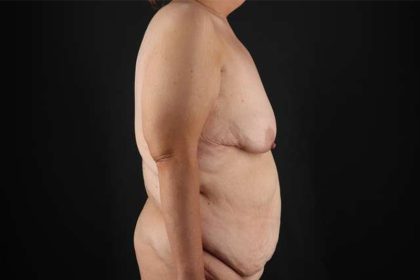 Fleur De Lis Circumferential Body Lift Before & After Patient #4186
