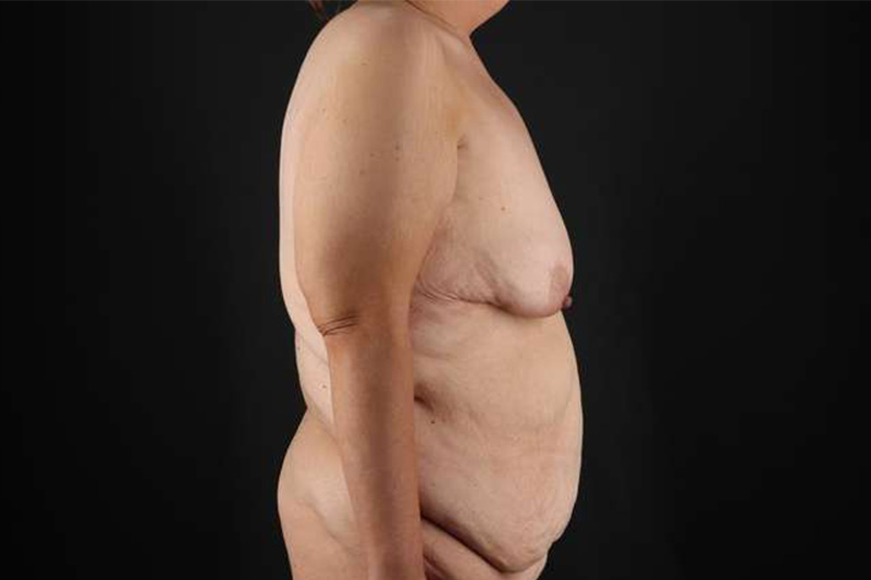 Fleur De Lis Circumferential Body Lift Before & After Patient #4186