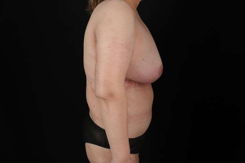 Fleur De Lis Circumferential Body Lift Before & After Patient #4186
