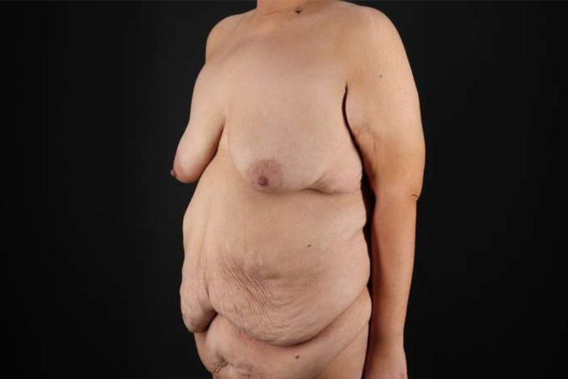 Fleur De Lis Circumferential Body Lift Before & After Patient #4186