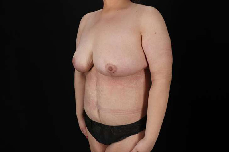 Fleur De Lis Circumferential Body Lift Before & After Patient #4186