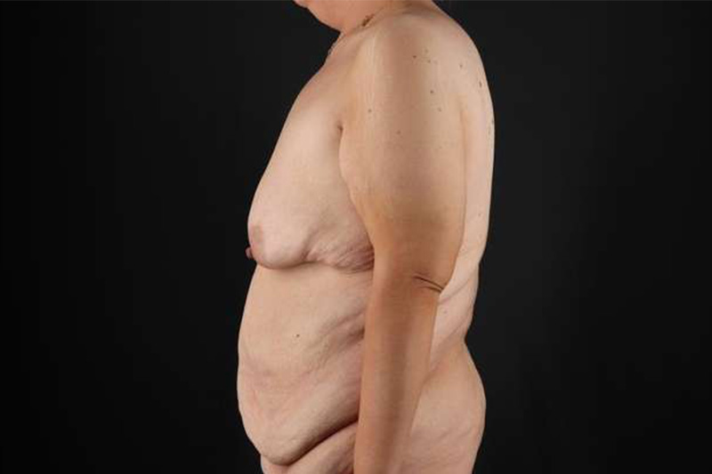 Fleur De Lis Circumferential Body Lift Before & After Patient #4186