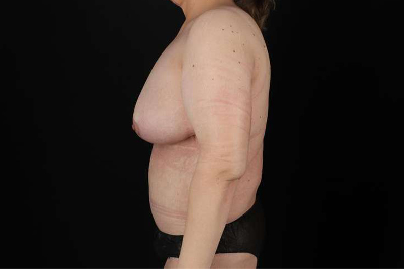 Fleur De Lis Circumferential Body Lift Before & After Patient #4186