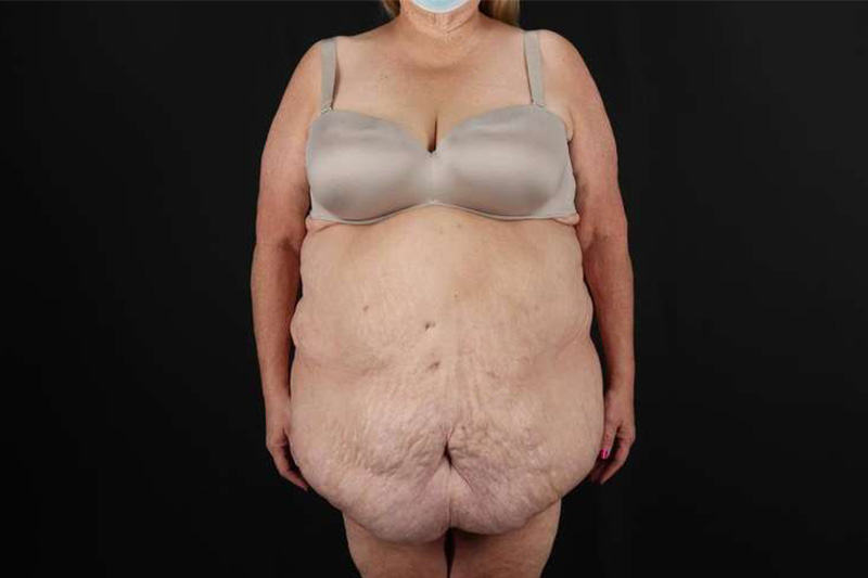 Fleur De Lis Circumferential Body Lift Before & After Patient #4199