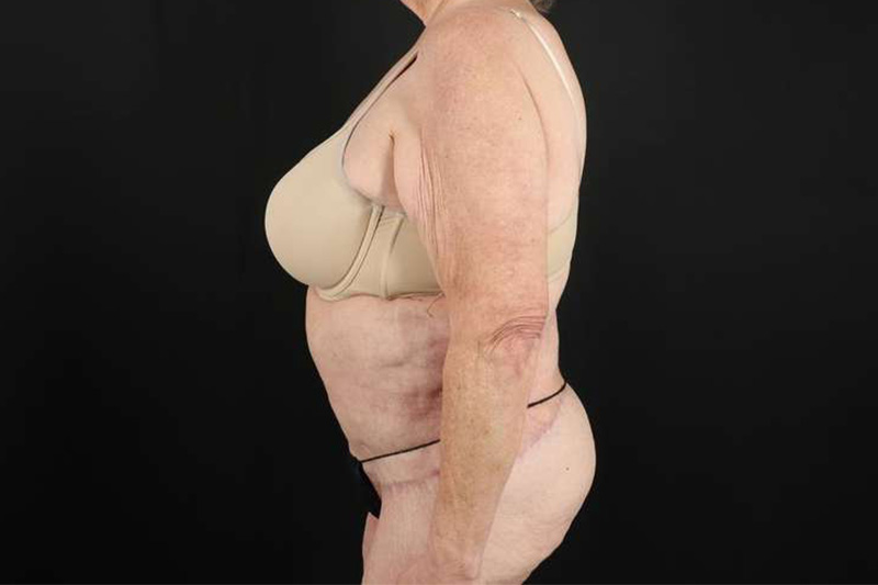 Fleur De Lis Circumferential Body Lift Before & After Patient #4199