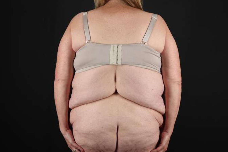 Fleur De Lis Circumferential Body Lift Before & After Patient #4199