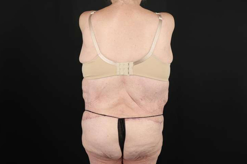 Fleur De Lis Circumferential Body Lift Before & After Patient #4199