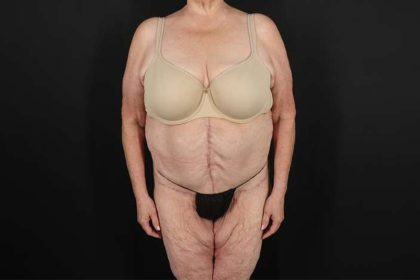 Fleur De Lis Circumferential Body Lift Before & After Patient #4199