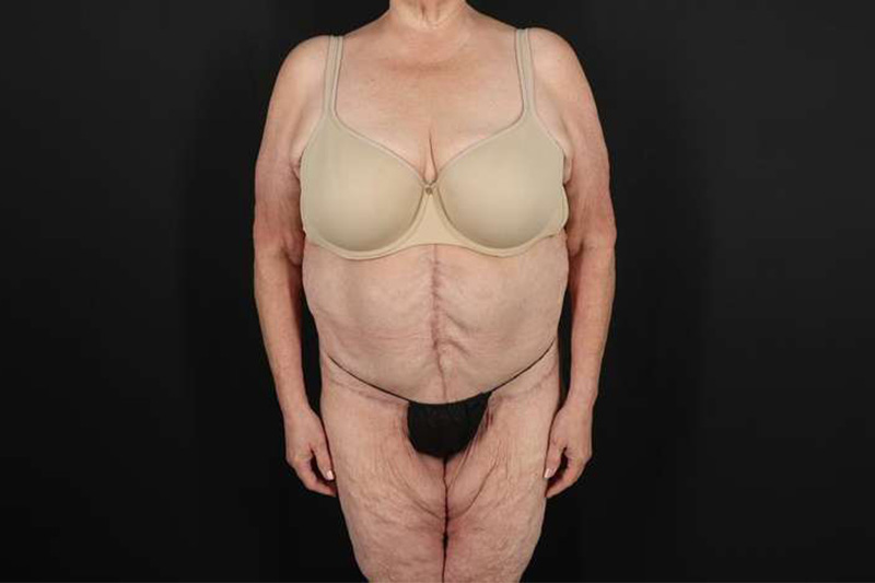 Fleur De Lis Circumferential Body Lift Before & After Patient #4199